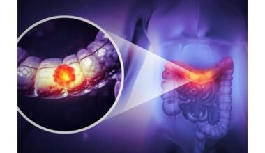 91 % didesnė gaubtinės žarnos vėžio rizika