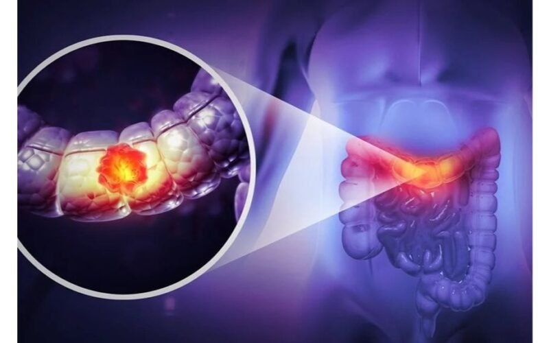 91 % didesnė gaubtinės žarnos vėžio rizika