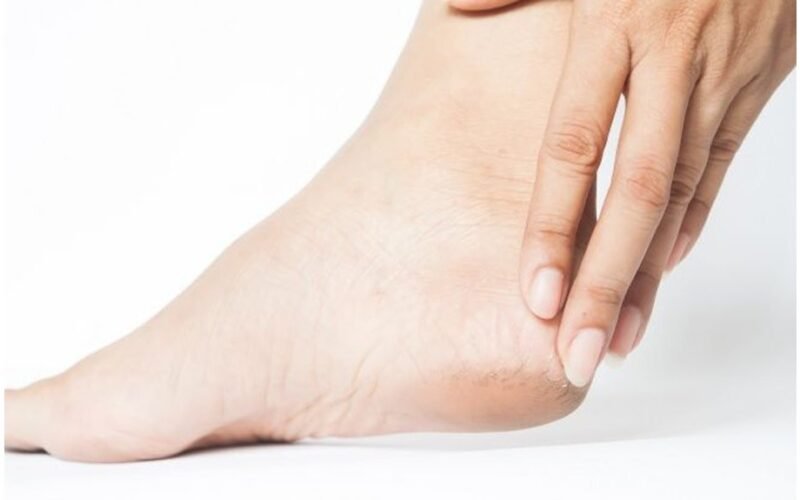 išgydyti suskilinėjusias kulnus namuose